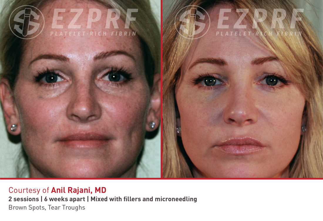 Skin Pen Microneedling—Is it for you?