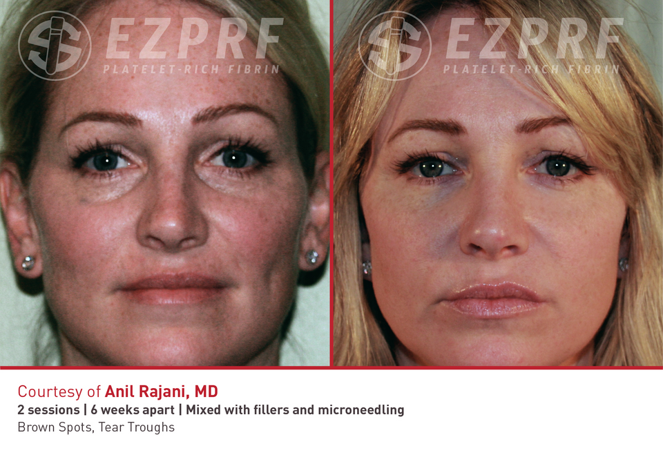 PRF microneedling with the SkinPen device at Green Medicine of Wisconsin